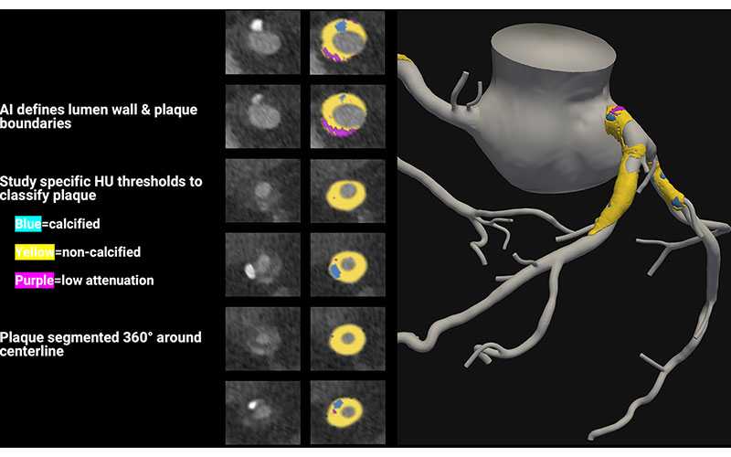 AI-based QCPA. Schematic illustration shows AI-based CT analysis of coronary plaque burden and composition. Rajiah et al RadioGraphics
