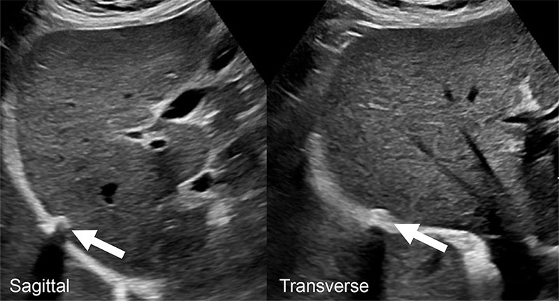 LI-RADS US-1 (negative) category in a 66-year-old woman with hepatitis C virus cirrhosis. 