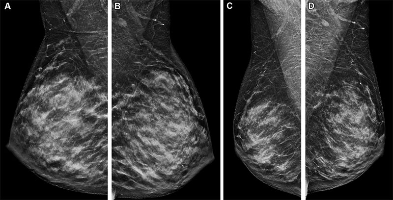 Mammographic changes related to lactation. Fig. 3 Ojeda-Fournier RG