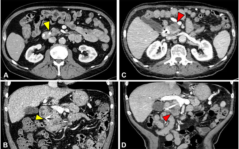 PDAC in a 52-year-old patient with chronic pancreatitis.