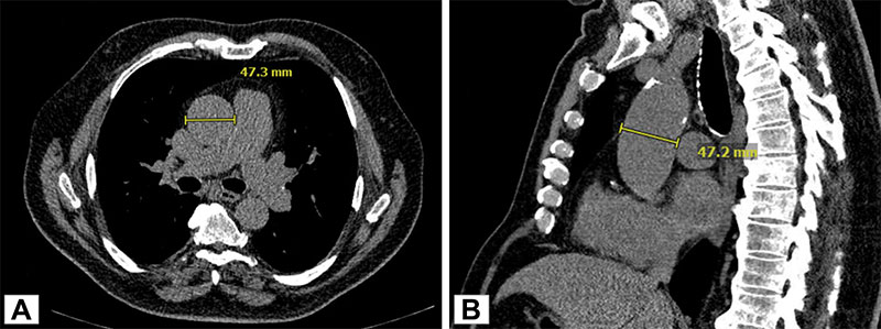 Byrne et al RadioGraphics Incidental finding of an ascending thoracic aortic aneurysm detected at lung cancer screening CT. 