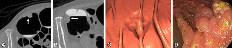 Large 25-mm tubulovillous adenoma in the cecum in a 71-year-old woman. Taya et al RadioGraphics