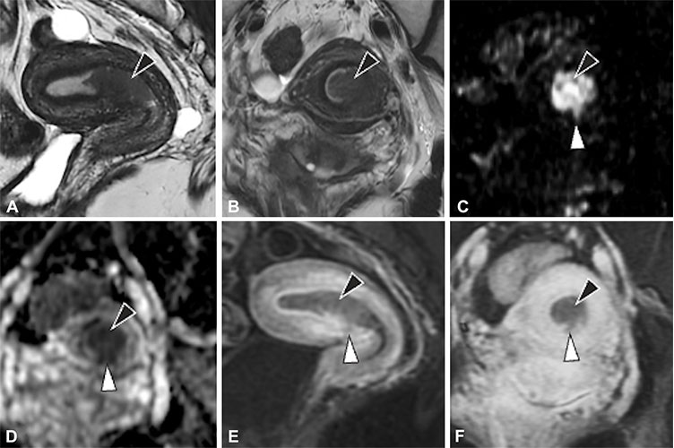 Endometrioid adenocarcinoma (FIGO stage I–II) with superficial myometrial invasion in a 39-year-old woman who presented with abnormal uterine bleeding Fig. 9 Jha RG