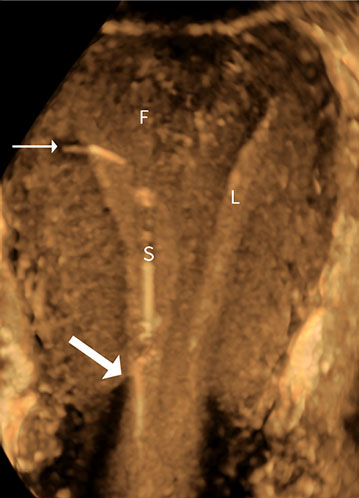 Septate uterus. Coronal 3D image shows the intrauterine device (IUD) stem (S) in the right uterine horn, greater than 1 cm below the fundal myometrium (F) and above the internal os (thick arrow). The IUD is described as nonfundal. 