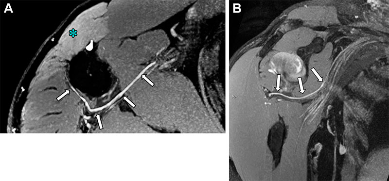 Axillary neuropathy in a 42-year-old man with posttraumatic deltoid weakness. Axial (A) and oblique sagittal (B) MIP double-echo steady state images show thickening and hyperintensity (arrows) of the anterior branch of the axillary nerve, curving around the surgical neck of the humerus