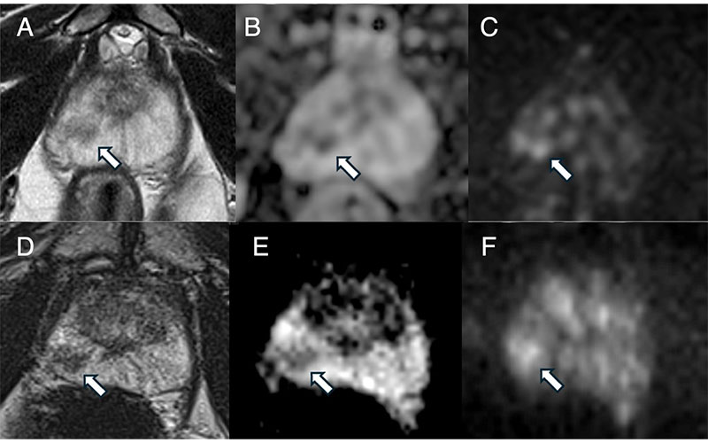 The importance of concordance between histologic findings and MRI in a 54-year-old male patient enrolled in an active surveillance (AS) program locally and referred for an opinion at our institution. 