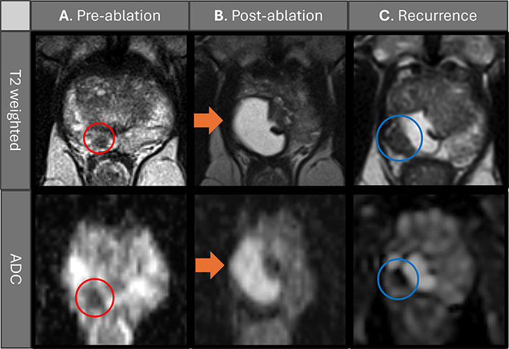 Preablation, postablation, and recurrence multiparametric MRI scans in a 63-year-old man treated with transperineal focal laser ablation (TPLA) for localized prostate cancer (PCa). 