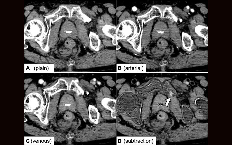 Axial dynamic contrast-enhanced CT images and a subtraction image in a 68-year-old male patient with a pelvic fracture are presented on black background.