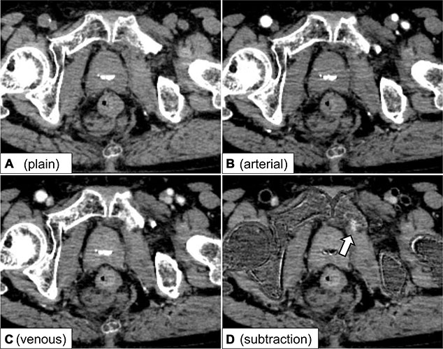Hirano Fig 2  Axial dynamic contrast-enhanced CT images and a subtraction image in a 68-year-old male patient with a pelvic fracture are presented
