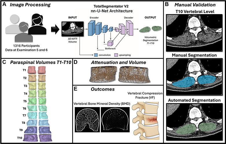 Study overview showing CT-based muscle segmentation, validation against manual measurements, 3D muscle analysis, and assessment of links to bone density and vertebral fractures.