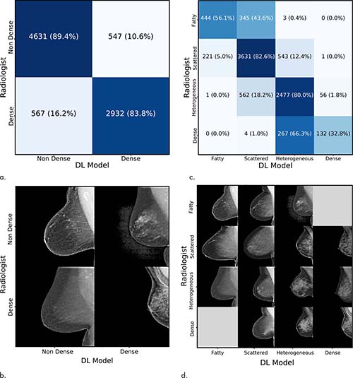 AI clinical practice breast density