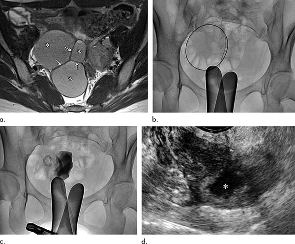 Clinical course of a 27-year-old woman with primary ovarian endometrioma