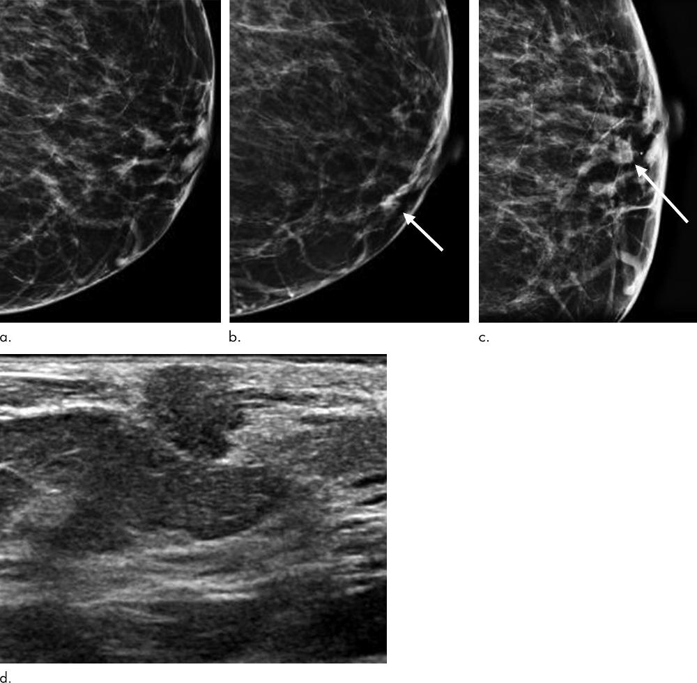 Digital Breast Tomosynthesis Improves Invasive Cancer Detection | RSNA