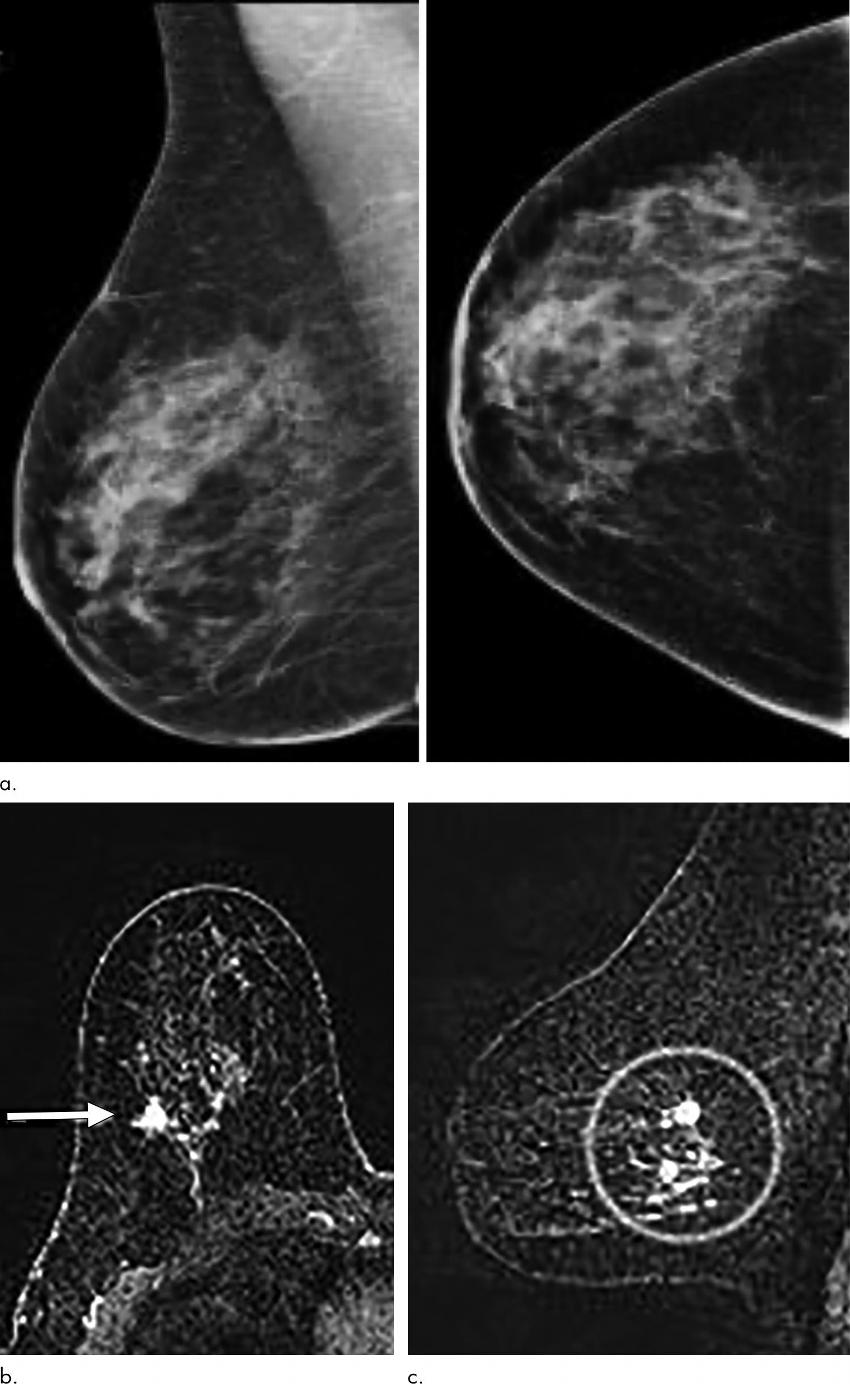 Digital Breast Tomosynthesis Improves Invasive Cancer Detection | RSNA